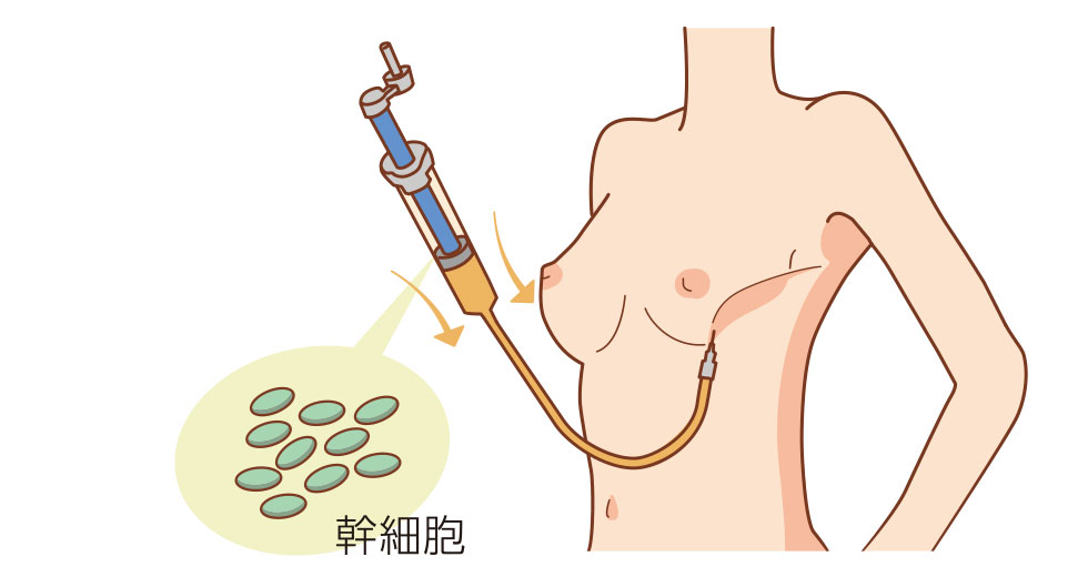 幹細胞を加えた脂肪の注入