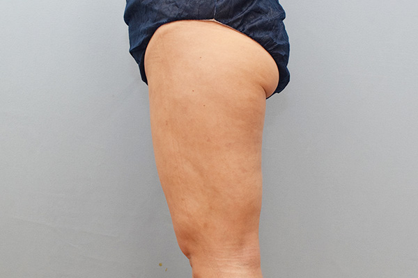 脂肪吸引術