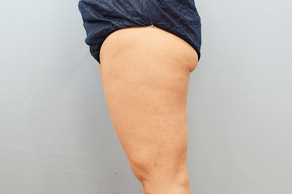 脂肪吸引術