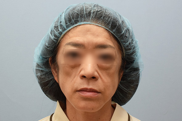 顔⾯変性疾患再建