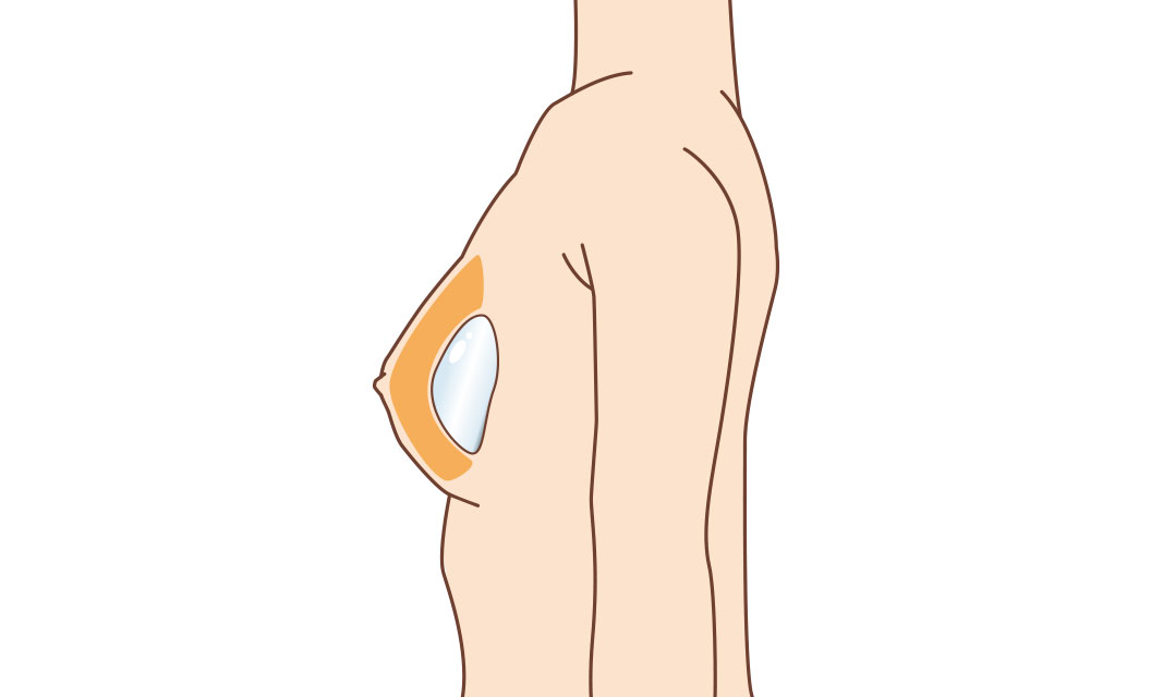 ボリュームある乳房を1回で再建したい方へ:インプラント併用CAL